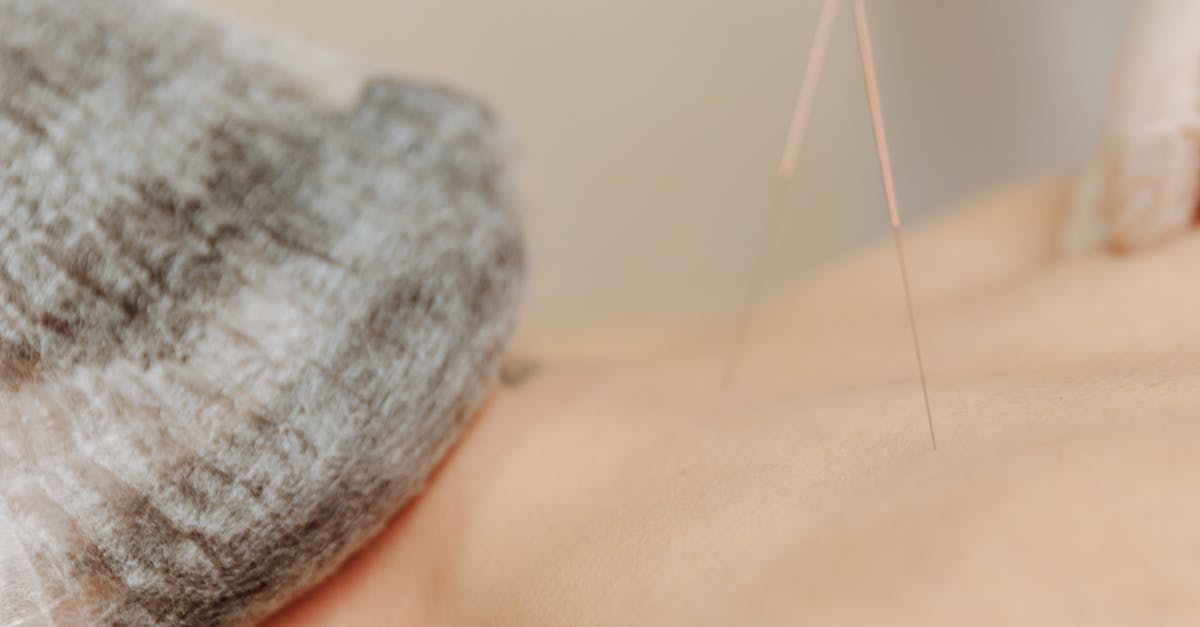Dry Needling: A Comprehensive Guide for First-Time Patients